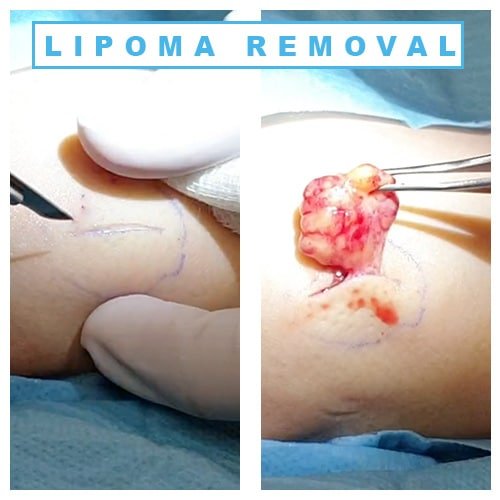 Lipoma Removal: Surgical Procedures and Aftercare
