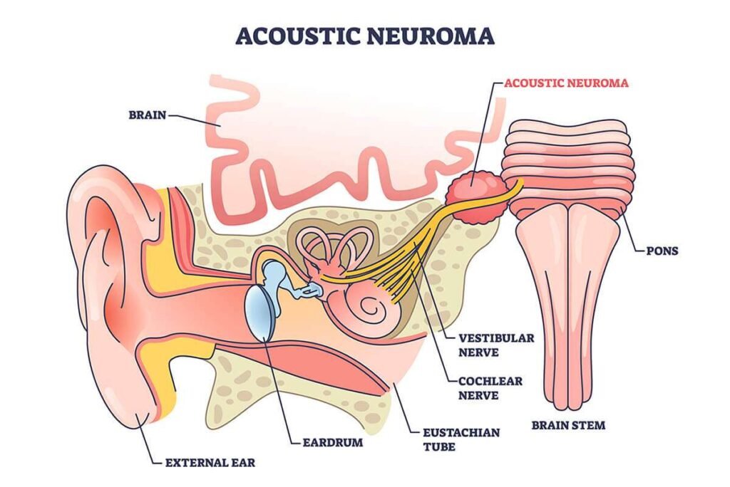 Living with Acoustic Neuroma: Coping Strategies and Support