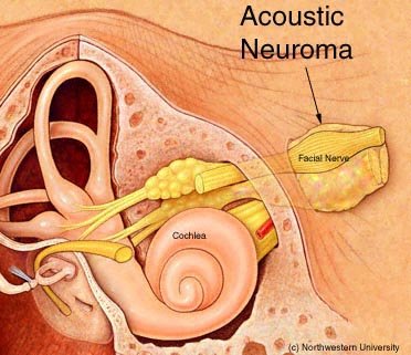 Living with Acoustic Neuroma: Coping Strategies and Support