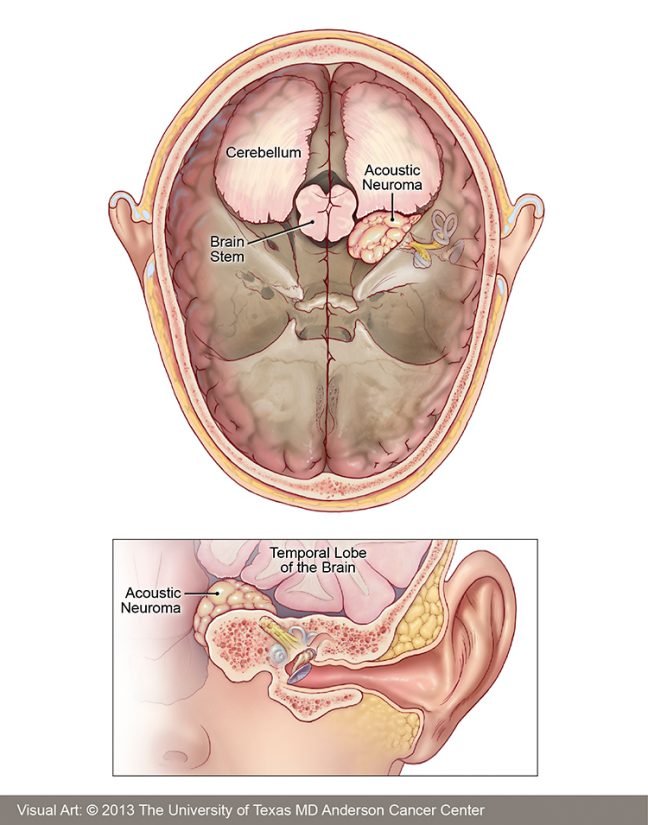 Living with Acoustic Neuroma: Coping Strategies and Support