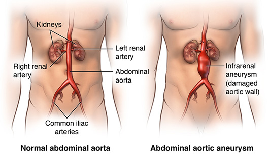 Living with an Abdominal Aortic Aneurysm