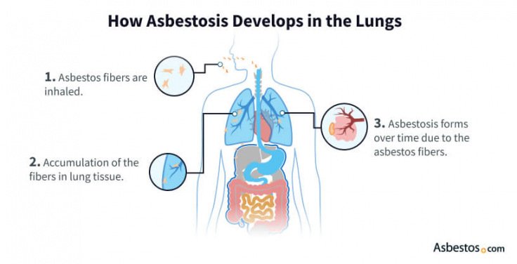 Living with Asbestosis: Managing the Symptoms and Enhancing Quality of Life