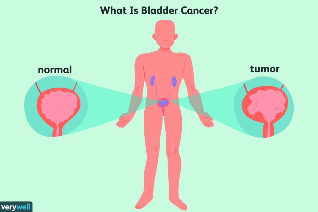 Living with Bladder Cancer: Tips for Coping and Support