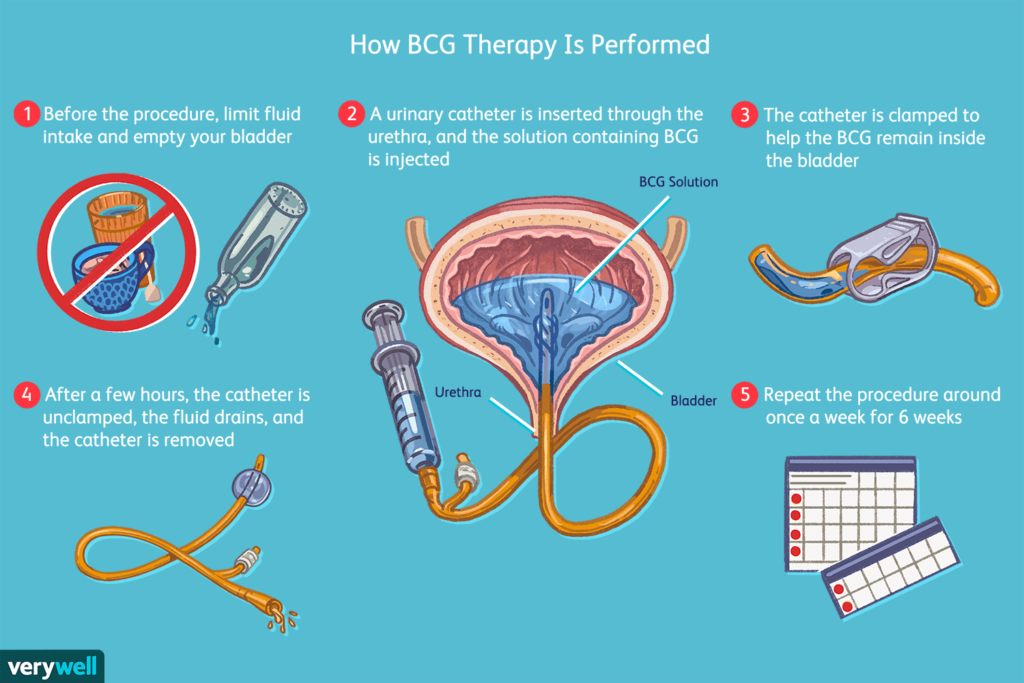 Living with Bladder Cancer: Tips for Coping and Support