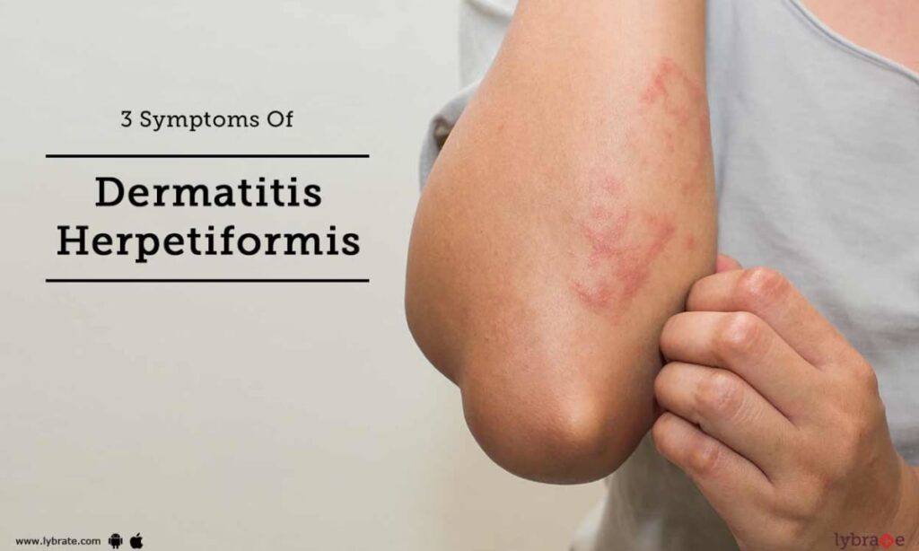Living with Dermatitis Herpetiformis: Coping Strategies and Support