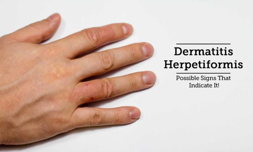 Living with Dermatitis Herpetiformis: Coping Strategies and Support
