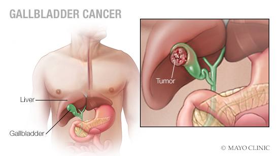 Living with Gallbladder Cancer