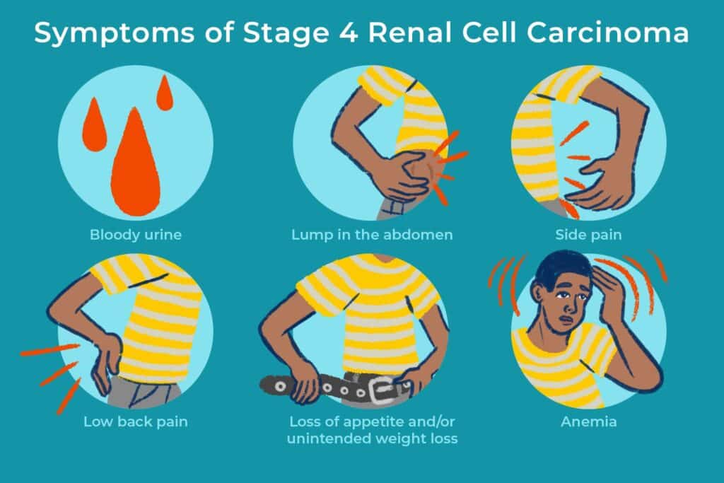 Living with Kidney Cancer: Tips for Coping and Support