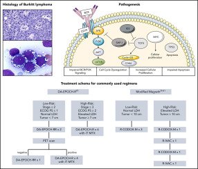 Management of Burkitt Lymphoma: Treatment Options