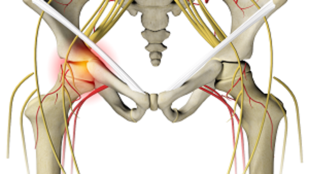 Managing and Treating Irritable Hip Syndrome in Adults