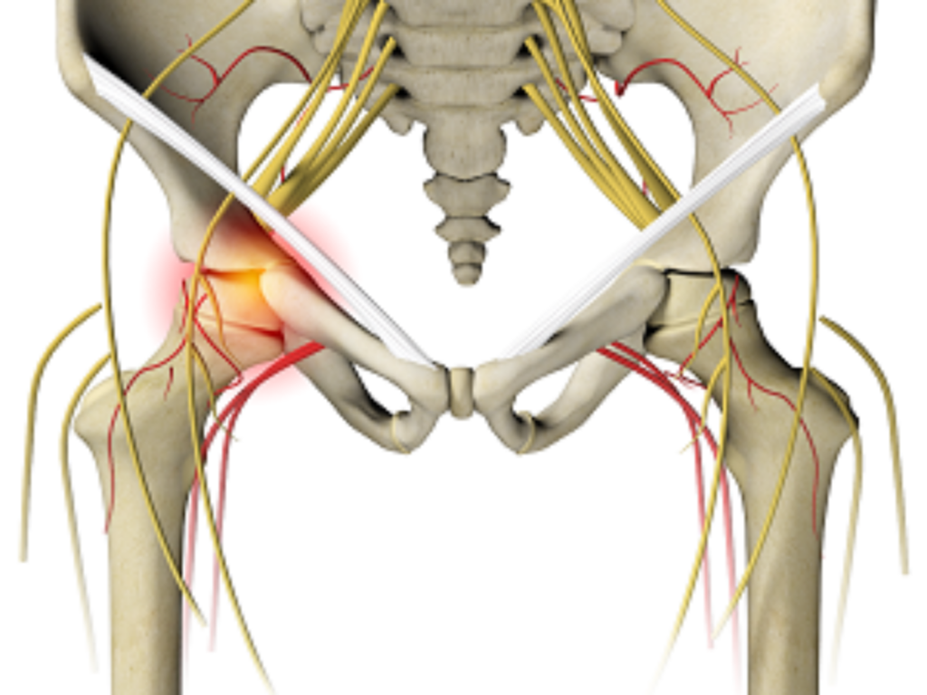 Managing and Treating Irritable Hip Syndrome in Adults