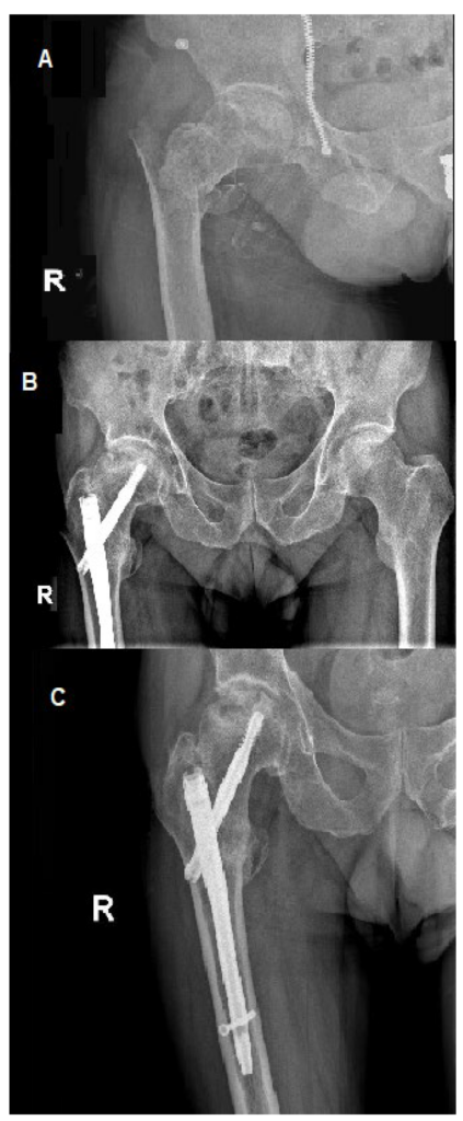 Managing Avascular Necrosis: A Comprehensive Guide