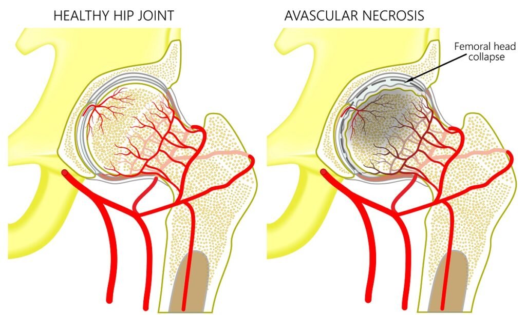 Managing Avascular Necrosis: A Comprehensive Guide