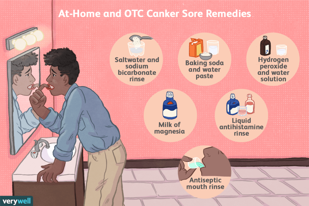 Managing Canker Sores: Tips for Relief