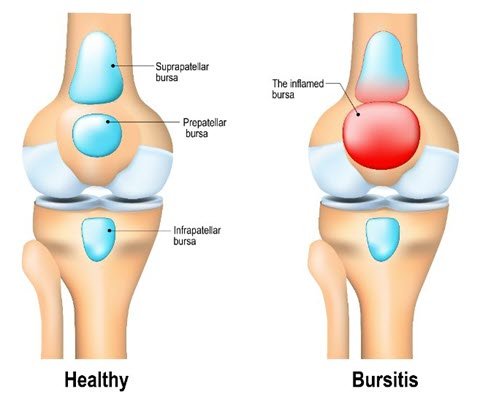 Managing Chronic Bursitis: Strategies for Long-Term Relief