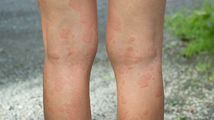 Managing Chronic Hives: Strategies for Long-Term Relief