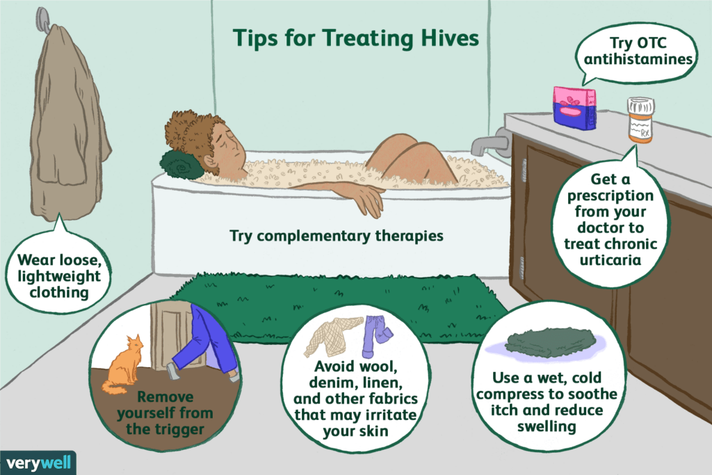 Managing Chronic Hives: Strategies for Long-Term Relief