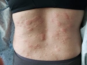 Managing Chronic Hives: Strategies for Long-Term Relief