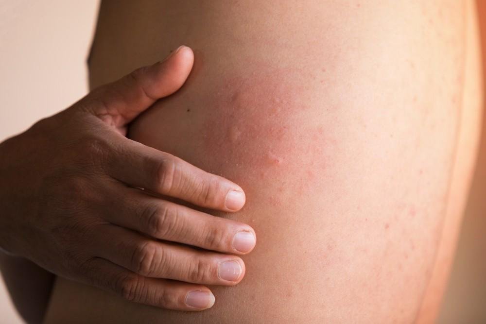 Managing Chronic Hives: Strategies for Long-Term Relief