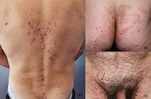 Managing Dermatitis Herpetiformis: Tips and Strategies Managing Dermatitis Herpetiformis: Tips and Strategies