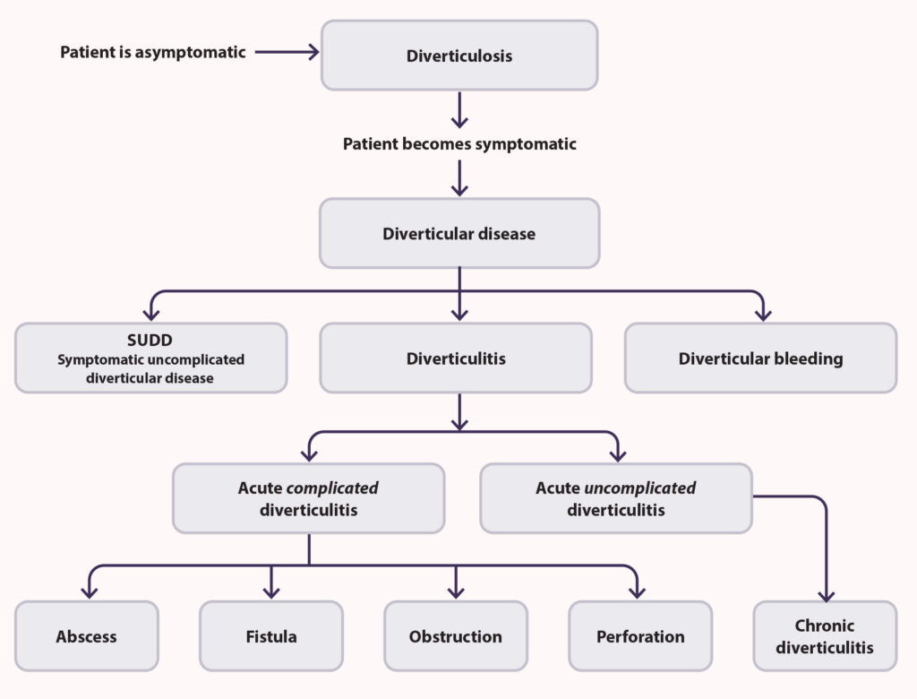 Managing Diverticular Disease