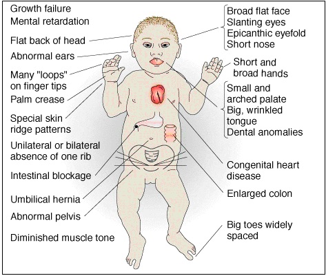 Managing Downs Syndrome