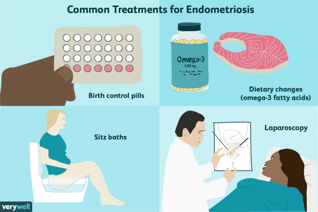 Managing Endometriosis: Treatment Options