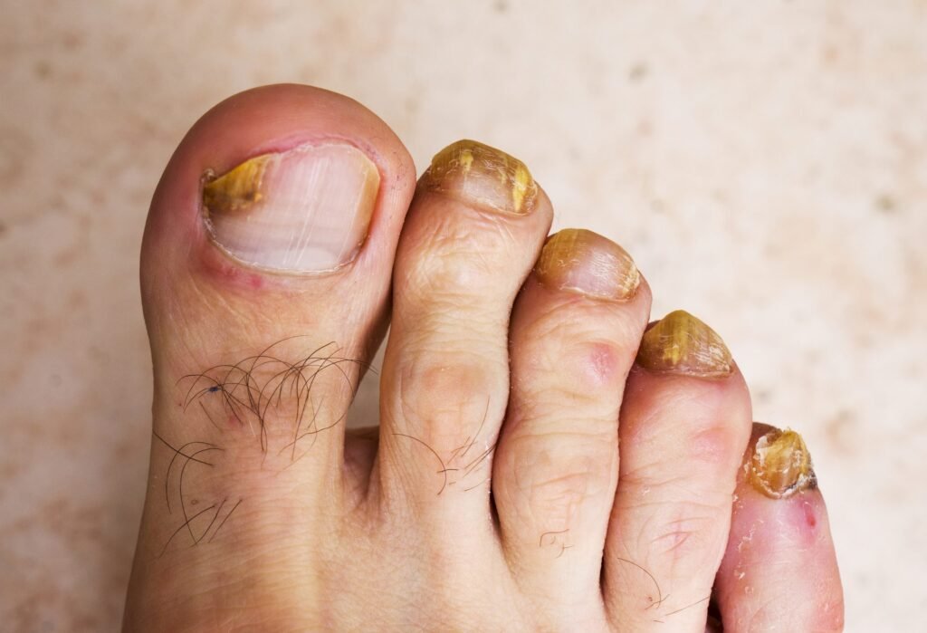 Managing Fungal Nail Infections