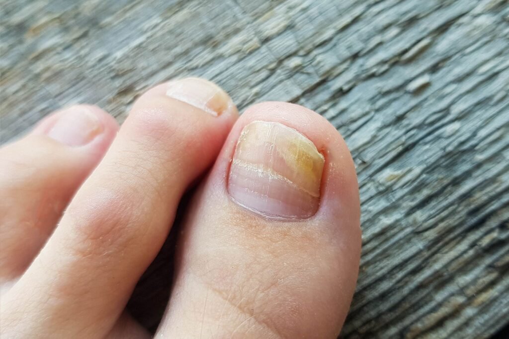 Managing Fungal Nail Infections