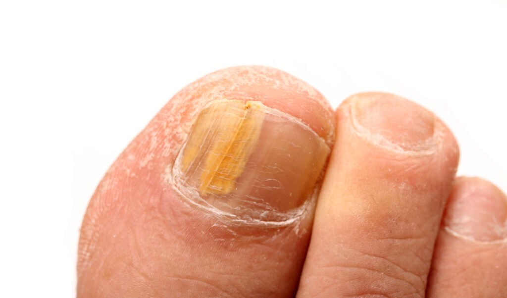 Managing Fungal Nail Infections