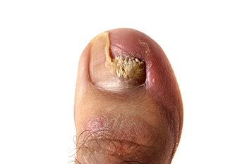 Managing Fungal Nail Infections