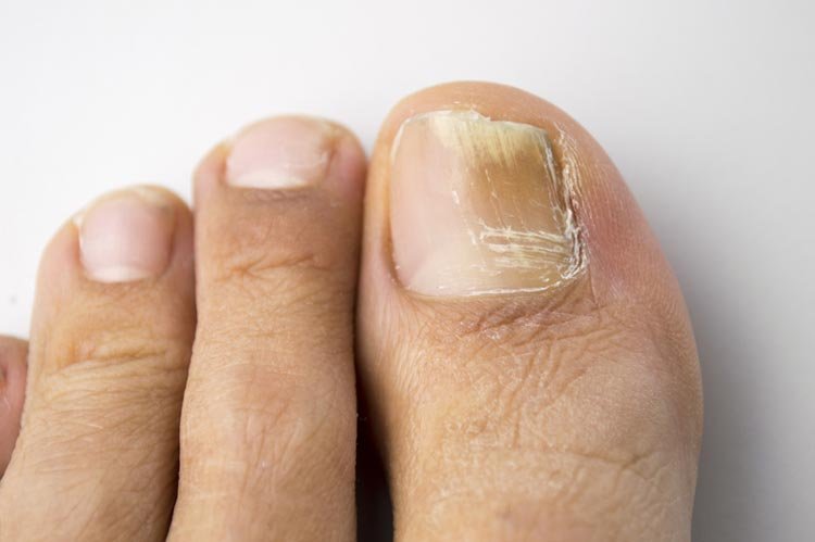 Managing Fungal Nail Infections