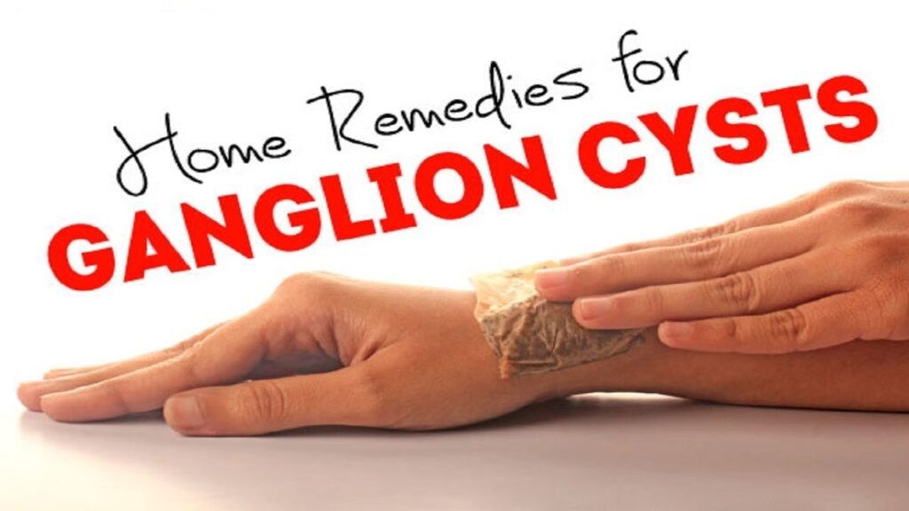 Managing Ganglion Cysts at Home: Natural Remedies and Prevention Tips