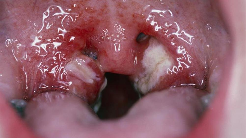Managing Glandular Fever: Coping Strategies and Recovery Tips