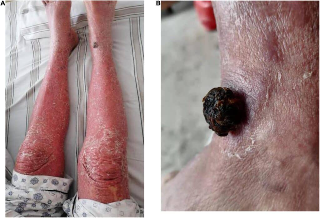 Managing Kaposis Sarcoma: Effective Treatment Strategies