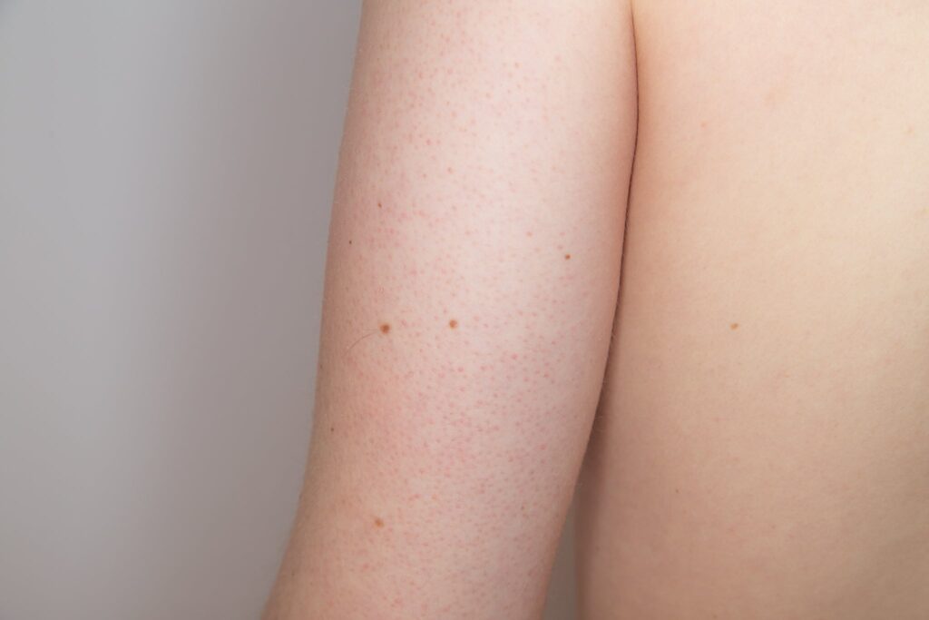 Managing Keratosis Pilaris: Strategies for Clearer Skin