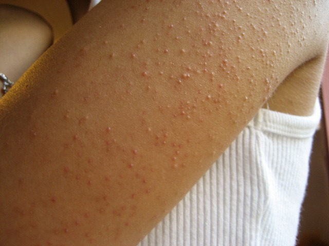 Managing Keratosis Pilaris: Strategies for Clearer Skin