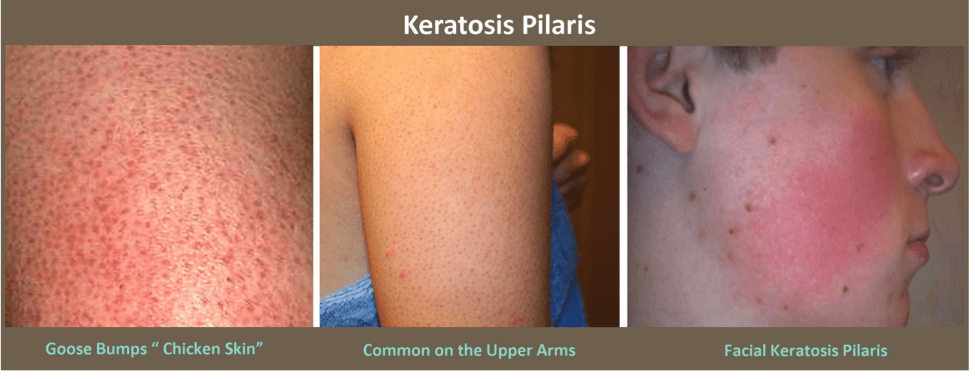 Managing Keratosis Pilaris: Strategies for Clearer Skin