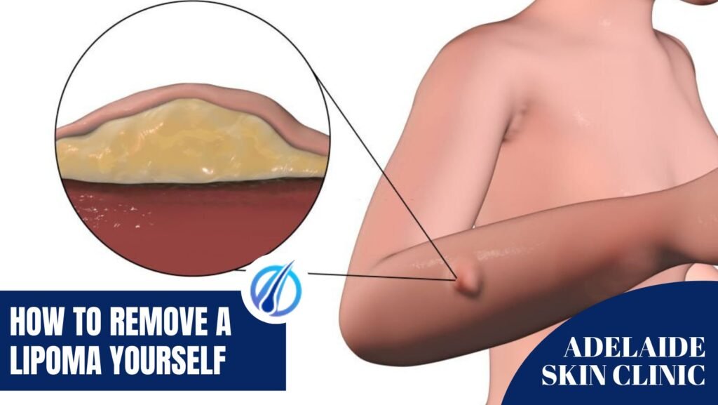Managing Lipoma: Effective Treatment Options