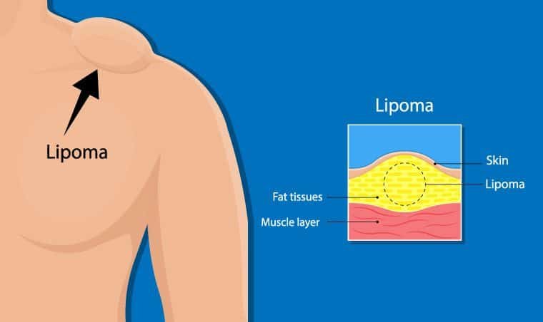 Managing Lipoma: Effective Treatment Options