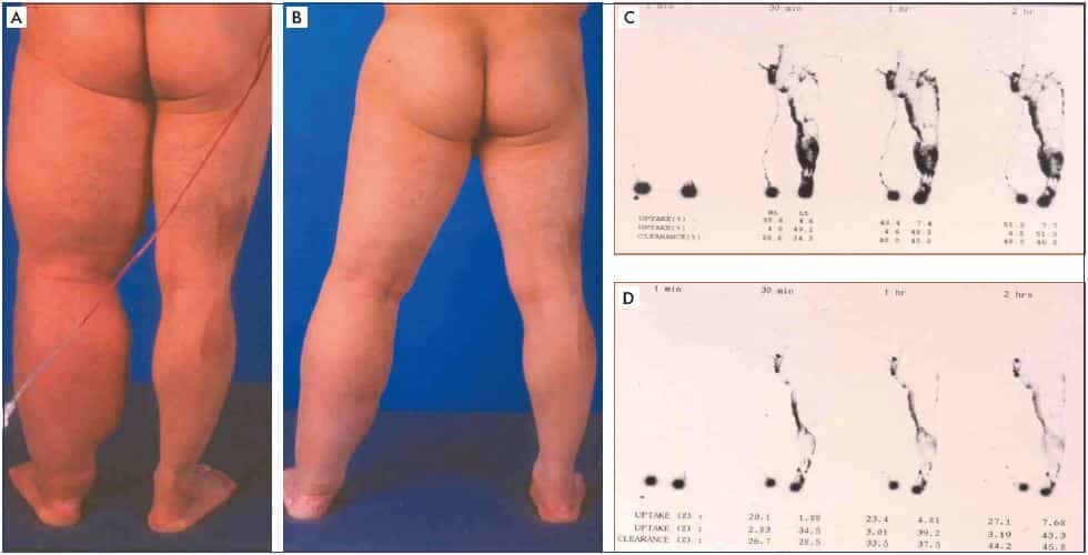 Managing Lymphoedema: Strategies and Techniques