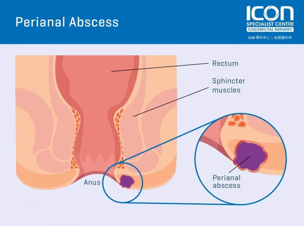 Managing Pain and Discomfort with Anal Abscesses