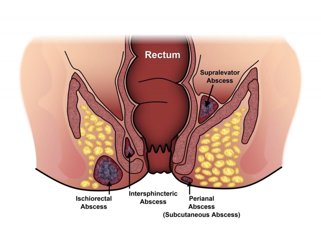 Managing Pain and Discomfort with Anal Abscesses