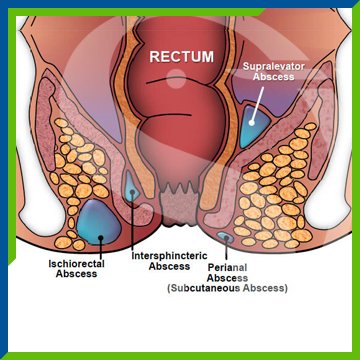 Managing Pain and Discomfort with Anal Abscesses