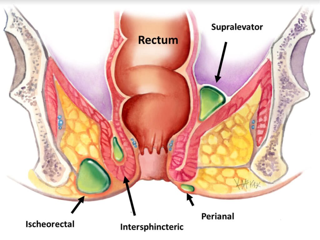Managing Pain and Discomfort with Anal Abscesses