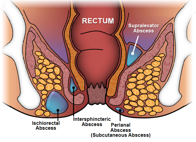 Managing Pain and Discomfort with Anal Abscesses