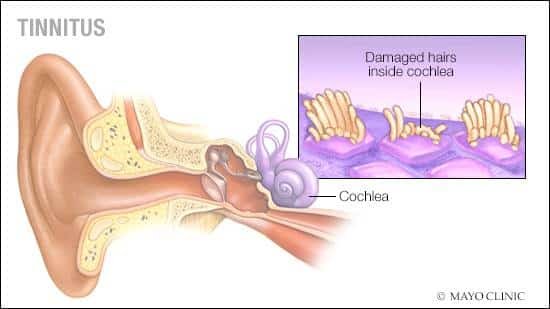Mayo Clinic Tinnitus Treatment