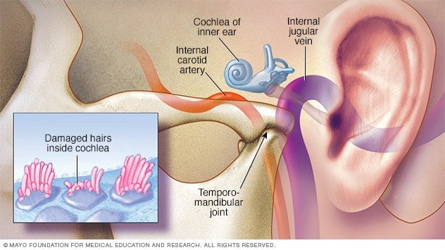 Mayo Clinic Tinnitus Treatment