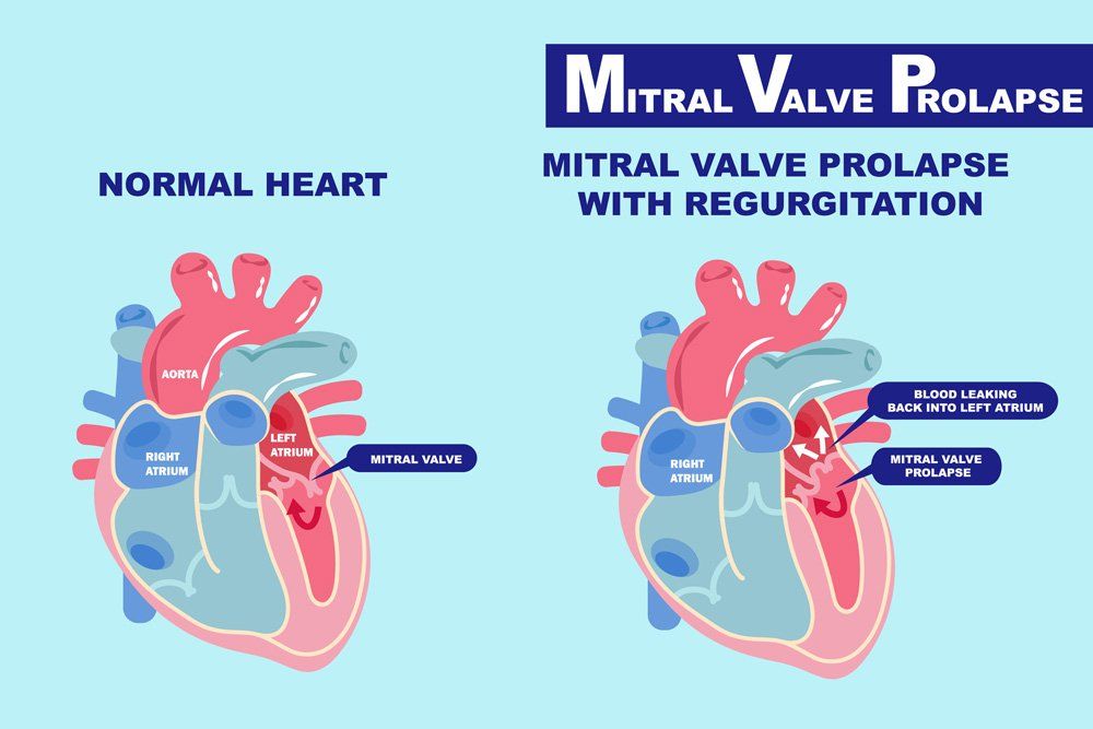 Mitral Valve Prolapse: Causes and Symptoms