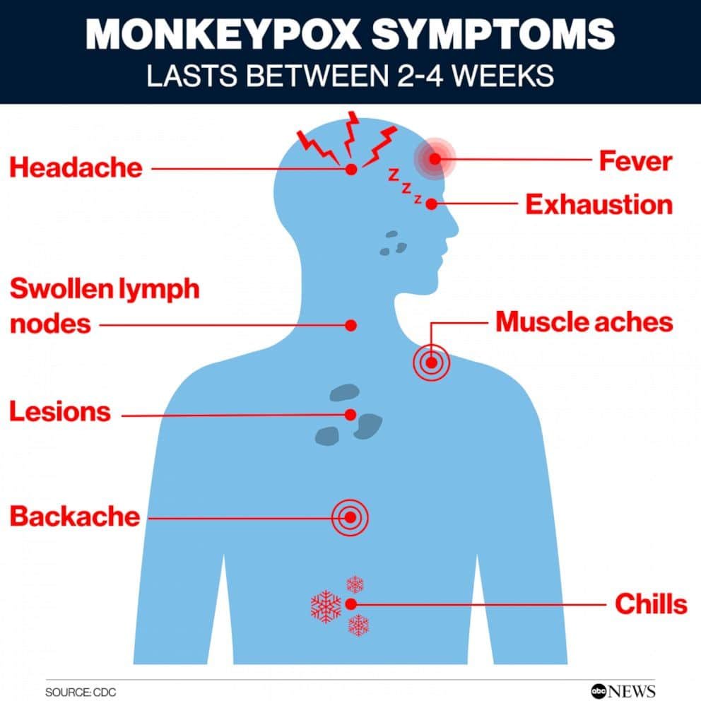 Monkeypox Outbreak: A Closer Look at the Symptoms and Prevention